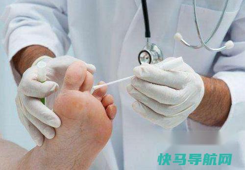 怎么治疗鸡眼不疼，能除根 第2张